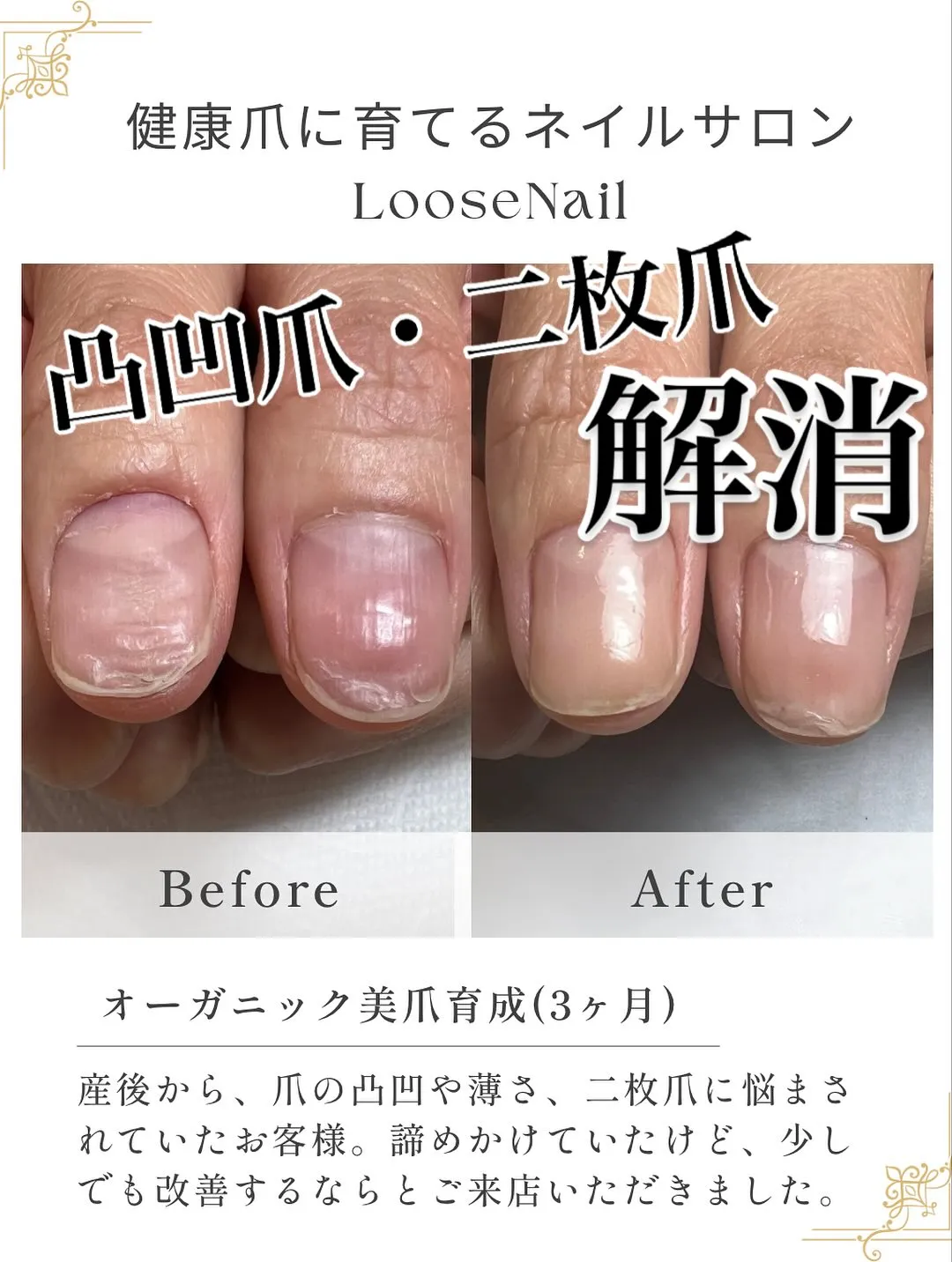 他の育爪症例はこちら→@mina_salon.loosena...