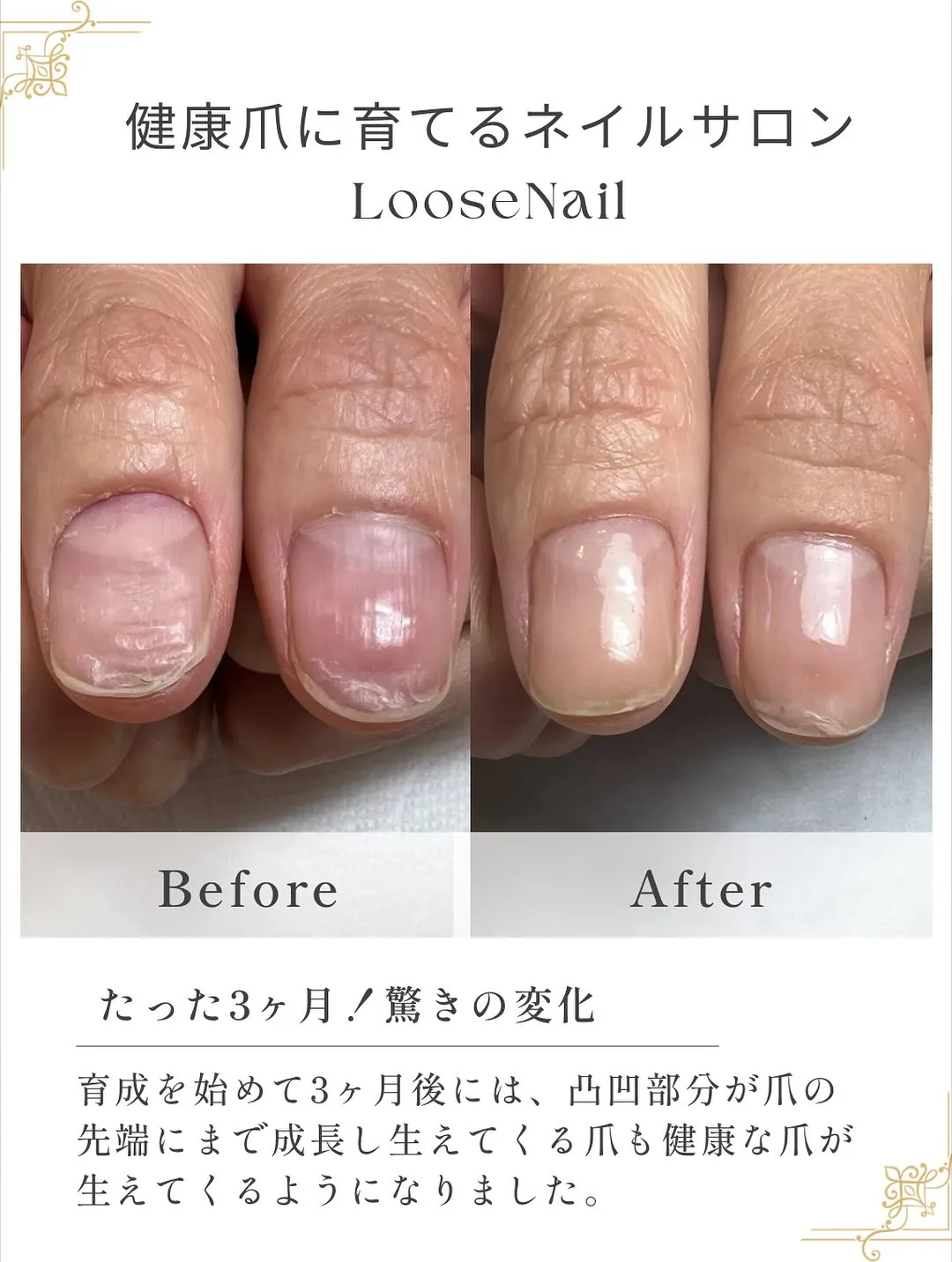 他の育爪症例はこちら→@mina_salon.loosena...
