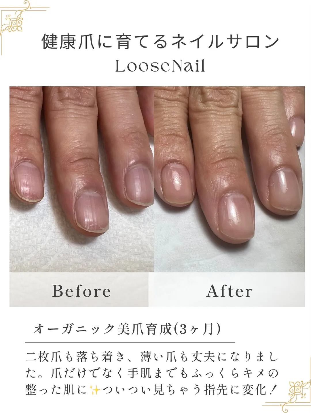 他の育爪症例はこちら→@mina_salon.loosena...